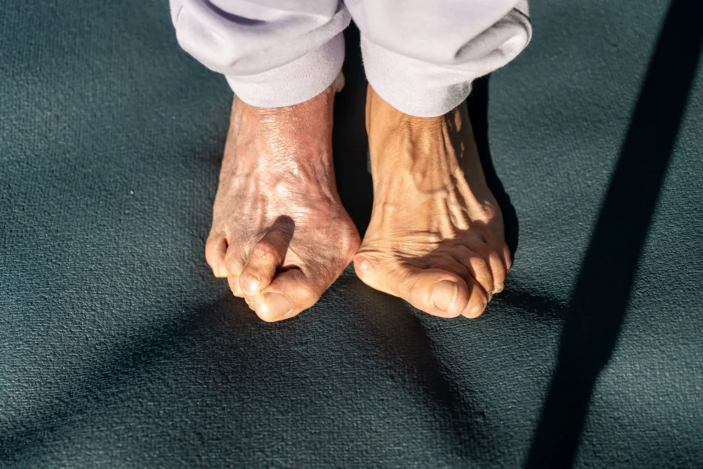 Bunions